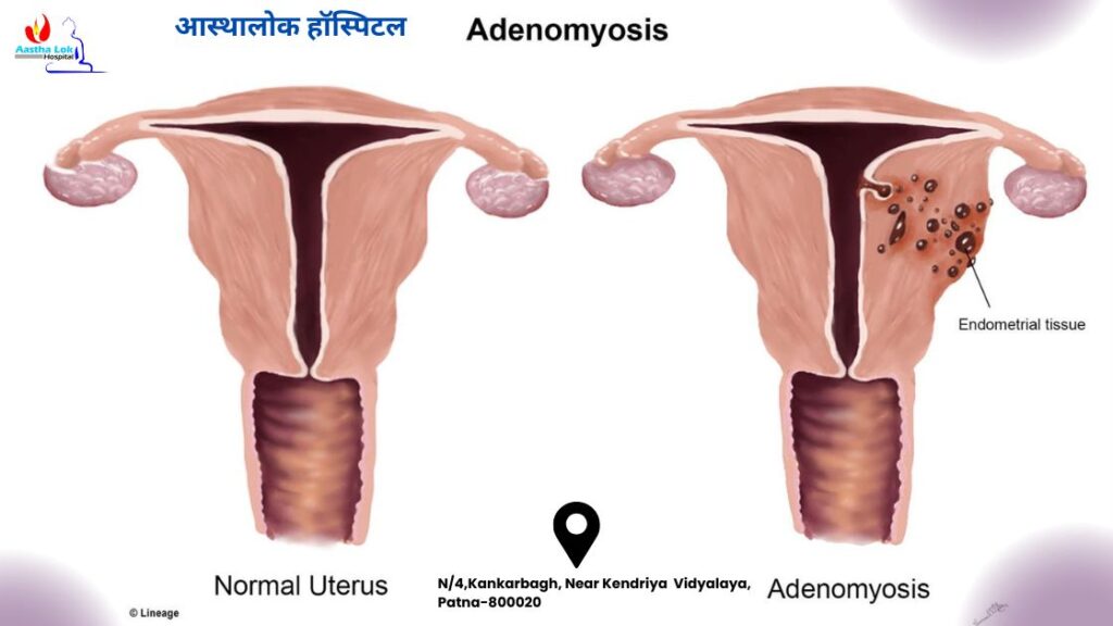 Adenomyosis