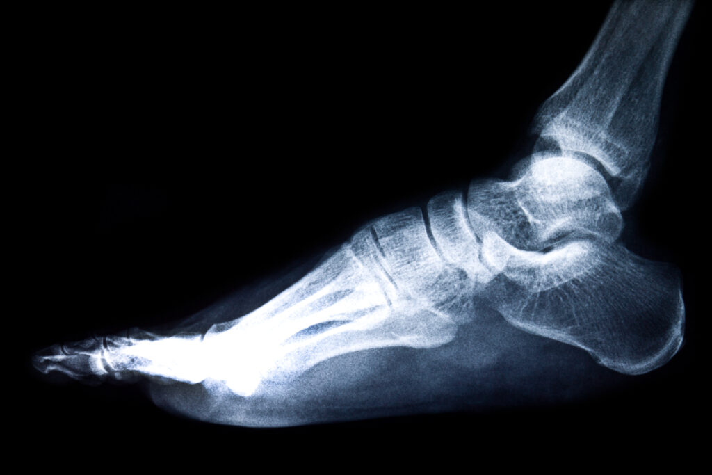 Ankle Fractures | Aastha Lok Hospital