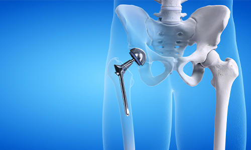 Affordable Hip Replacement Surgery in Patna