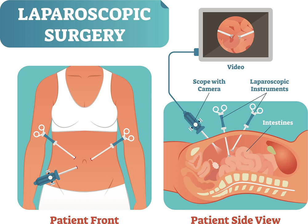 Say Goodbye to Big Cuts! Choose Laparoscopic Surgery in Patna | AasthaLok Hospital