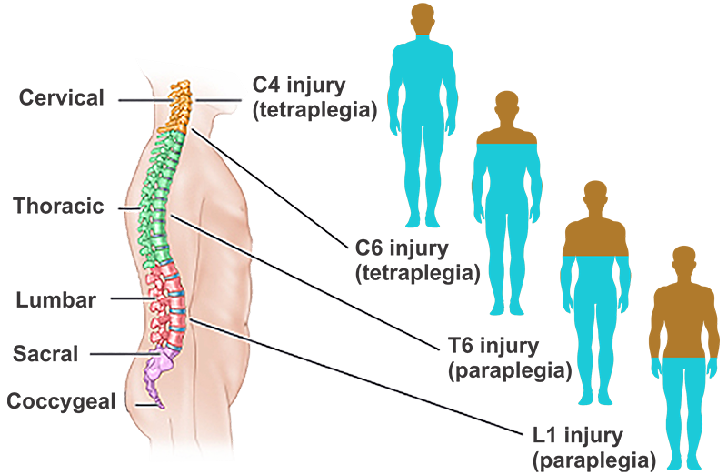 Spinal Injury Treatment | AasthaLok Hospital