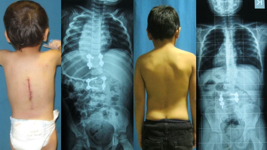 Scoliosis Deformity Correction Surgery | Best Spine Hospital in Patna | AasthaLok Hospital