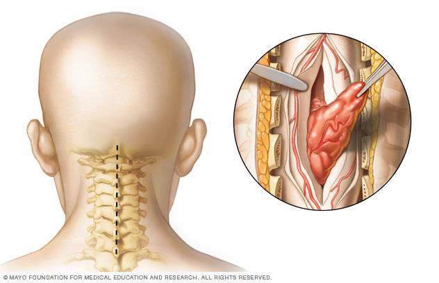 Understanding Spinal Tumors | AasthaLok Hospital